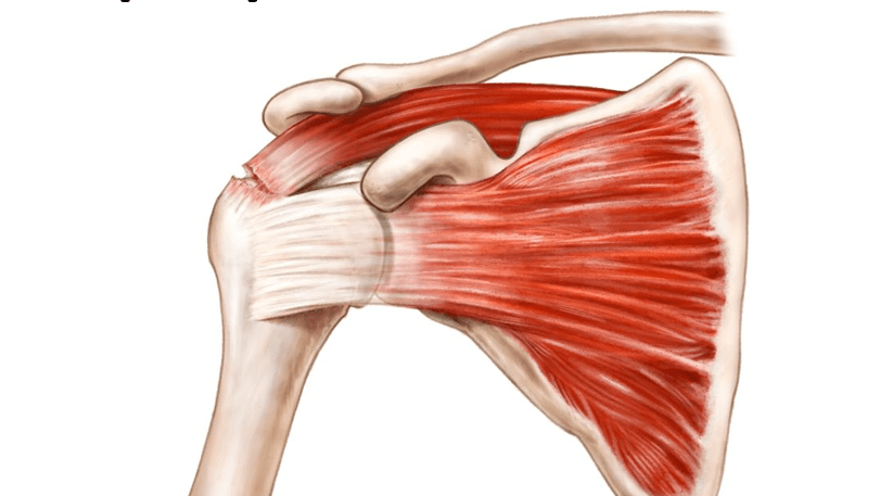découvrez tout sur la déchirure du tendon sus-épineux : symptômes, causes, diagnostic et traitements pour favoriser la guérison et soulager la douleur.
