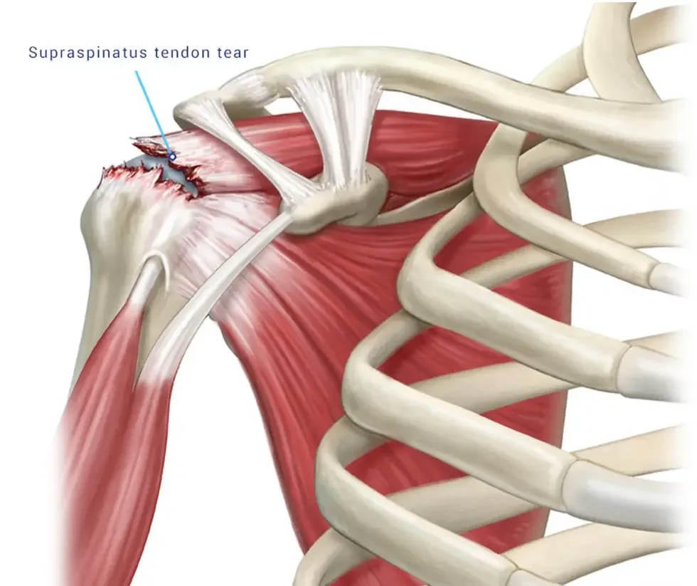 découvrez les causes, symptômes et traitements de la déchirure du tendon supra-épineux pour mieux comprendre cette blessure de l'épaule et favoriser une récupération efficace.